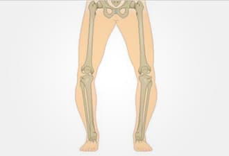 bow legs or rickets