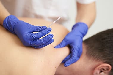 dry needling dubai | Dry Needling Therapy: Benefits, Uses & Side Effects