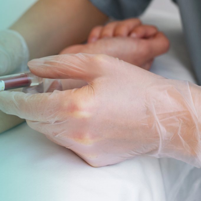A nurse in gloves drawing blood from a patient&rsquo;s arm