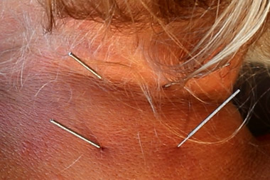 dry needling